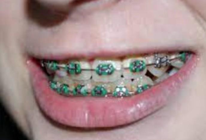 Ортодонт Боловина предупредила о противопоказаниях при установке брекетов
