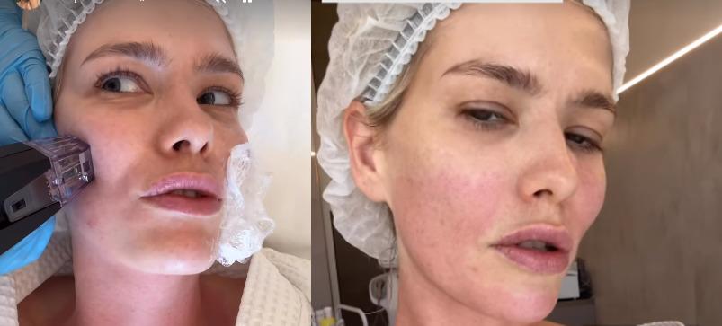 Елена Перминова показала лицо без макияжа в кабинете косметолога Елена Перминова показала лицо без макияжа в кабинете косметолога