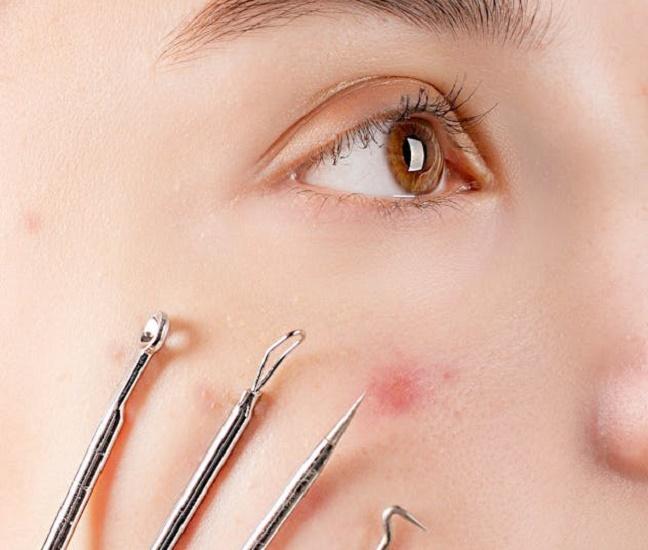 Дерматолог предупредила о риске инсульта из-за выдавливания прыщей у носа и губ