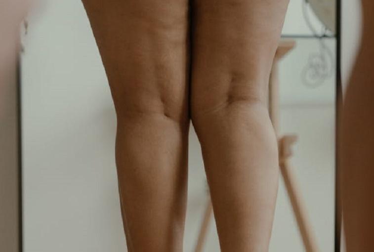 Хирург Казарян: Липосакция не поможет избавиться от целлюлита