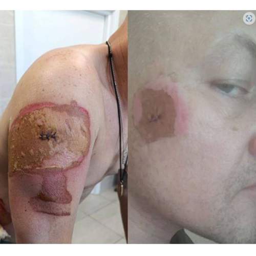 ВСУ сбросили дрон с токсичным веществом на советника главы ДНР Яна Гагина (ФОТО)