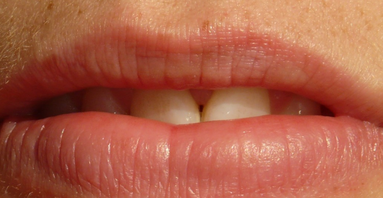 Стоматолог Сумцова рассказала о развитии стоматита и кандидоза из-за сухости во рту Стоматолог Сумцова рассказала о развитии стоматита и кандидоза из-за сухости во рту