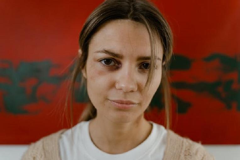 Косметолог Егорова рассказала, как избавиться от синяков под глазами