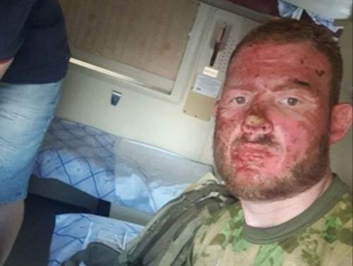 «Меня спасли салфетки»: боец ВС РФ чудом выжил после химической атаки ВСУ (ВИДЕО)