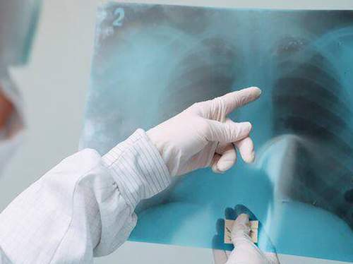 В России зафиксирована вспышка микоплазменной пневмонии: названы симптомы опасной болезни