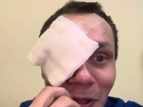 «Ничего страшного»: боец поп-ММА Корней Тарасов лишился глаза из-за удара девушки (ВИДЕО)