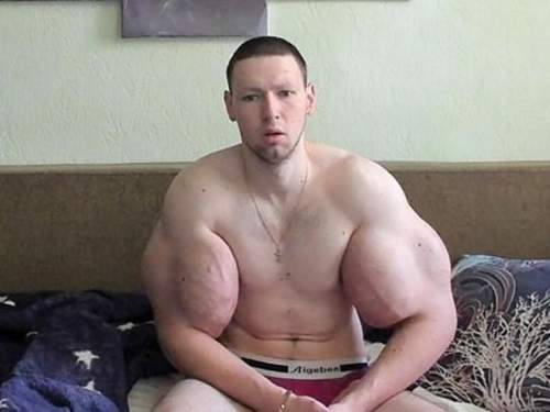 У блогера Руки-Базуки начала гнить рука: фото ужаснули россиян (ФОТО)