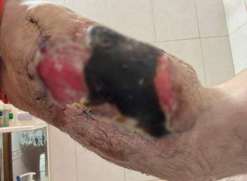 У блогера Руки-Базуки начала гнить рука: фото ужаснули россиян (ФОТО)