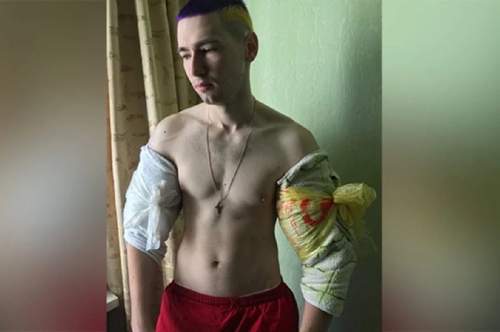 У блогера Руки-Базуки начала гнить рука: фото ужаснули россиян (ФОТО)