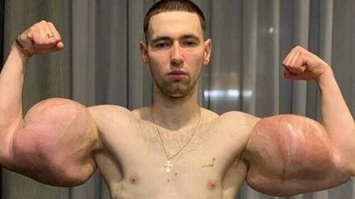 У блогера Руки-Базуки начала гнить рука: фото ужаснули россиян (ФОТО)