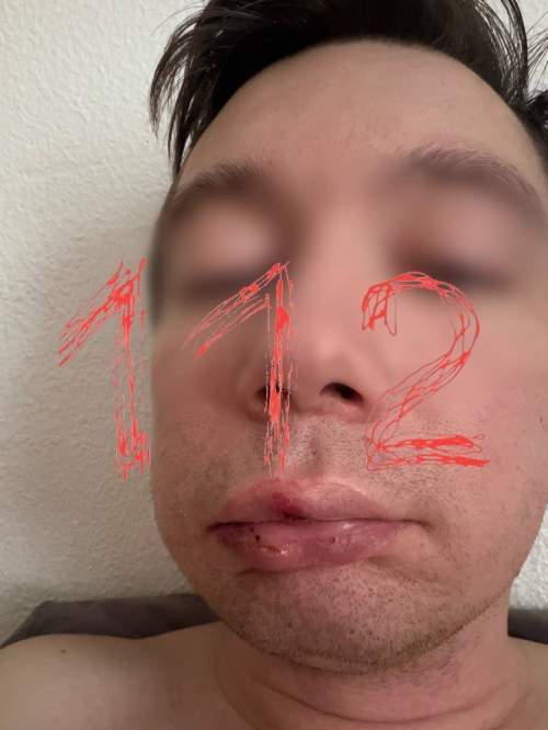 Сына зампредседателя комитета в Петербурге избили пьяные гопники (ФОТО)