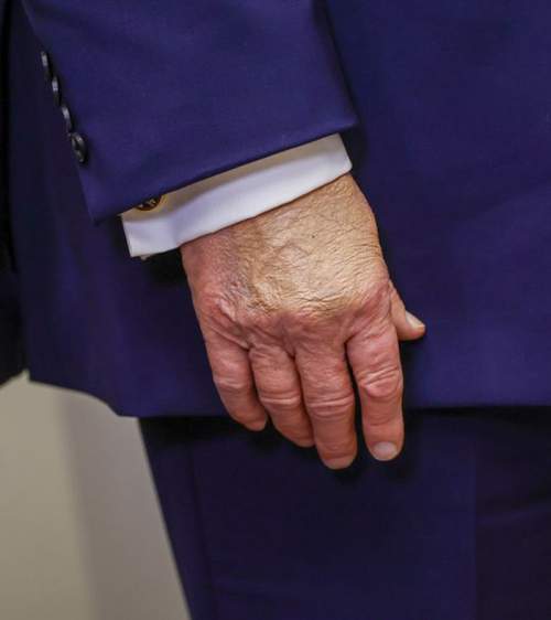 Трамп в Рождество появился с синяками на запястьях (ФОТО)