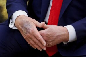 Трамп объяснил, откуда у него появляются чудовищные синяки на руках (ФОТО)