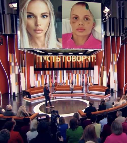 Лишившаяся части черепа модель Тарасова помирилась с бойфрендом-истязателем (ФОТО)