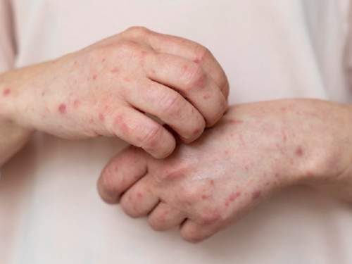 В Подмосковье госпитализированы мужчины с подозрением на заболевание оспой обезьян (ФОТО)