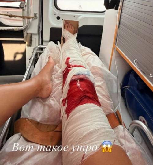 Ольга Бузова показала жуткие кадры из скорой после падения в душе (ФОТО) Ольга Бузова показала жуткие кадры из скорой после падения в душе (ФОТО)